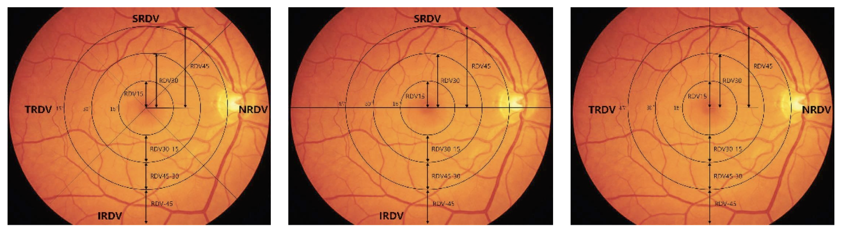 Multispectral refractive topography may be used in the future as an objective method to assess peripheral refraction in multiple discrete regions in patients with or at risk for developing myopia.