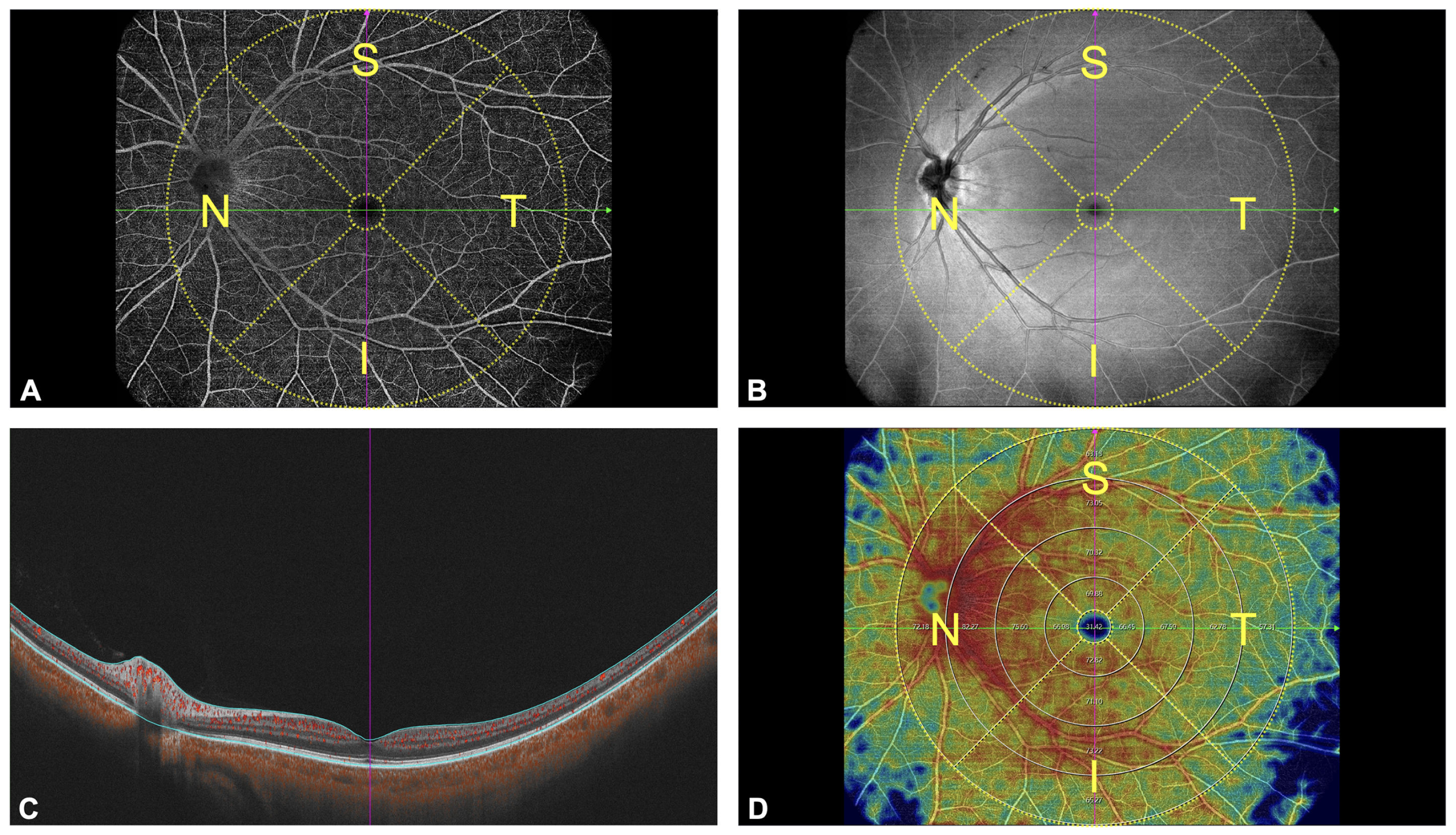 The authors speculate the reason that retinal microvasculature might be more affected by axial elongation on the temporal side is because of larger vessel presence in proximity to the nasal side of the optic disc. This image from the study shows (A) a 15x12mm2 widefield OCT-A scan, (B) the corresponding en-face image, (C) a B-scan image and  (D) measurement of the capillary density in annular regions of 1-3mm, 3-6mm, 6-9mm and 9-12mm in diameter, which were further divided into four quadrants(inferior, nasal, superior, temporal).