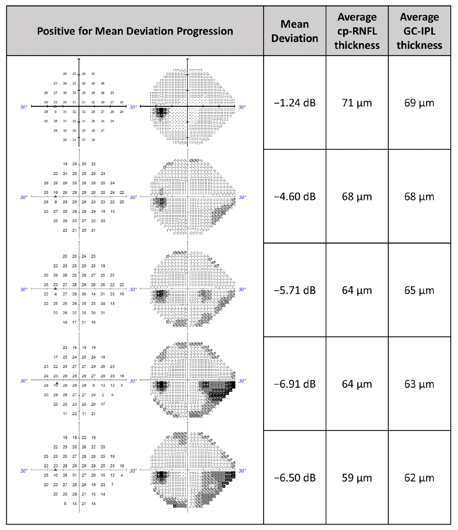 While cp-RNFL and GC-IPL both help predict 24-2 visual field progression in glaucoma patients, combining the two didn’t significantly enhance detection in a recent study. This image from the study shows a representative clinical case in which machine learning and statistical models predicted MD progression when using cp-RNFL thickness, GC-IPL thickness and both (combined).