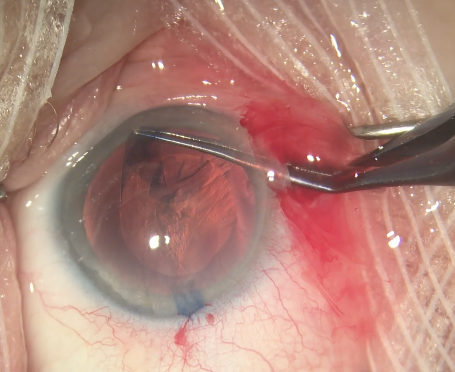 Baseline IOP was the characteristic with the strongest relationship to IOP response failure as eyes with higher baseline IOP were more likely to maintain this reduction after surgery. Nearly all glaucoma diagnoses had greater odds of IOP response failure compared to glaucoma suspect eyes.