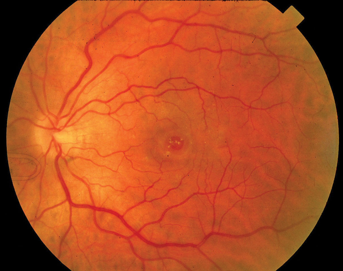 Though FDP may confer more benefits on patients with macular holes with minimum linear diameters ≥400µm, the findings of this study don’t support a linear treatment variation by macular hole size. The anatomic and visual effects in holes ≥500µm weren’t as certain.