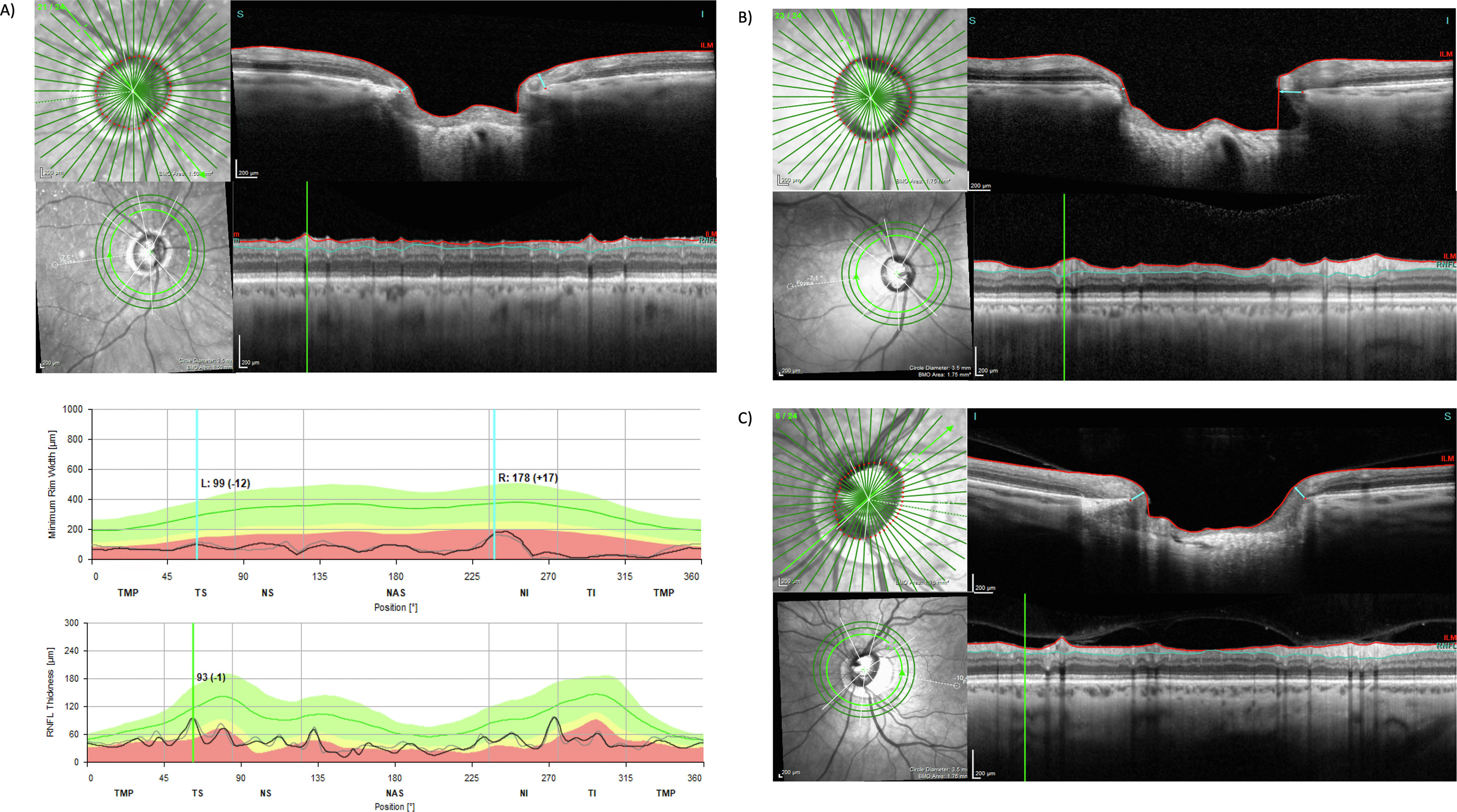 Among a cohort of glaucoma patients from the Advanced Glaucoma Progression Study, researchers found an overall low rate of mismatches involving BMO-MRW and RNFL thickness (8%), 80% of which were attributed to retinal blood vessels. These images from the paper show (A) how a large blood vessel thickens the RNFL more than the BMO-MRW at the 60° sector, (B) how a large blood vessel preferentially thickens the RNFL at the 75° sector due to the angular offset between the site of vessel insertion at the optic nerve head and the trajectory of the vessel in the retina and (C) how a small blood vessel preferentially thickens the BMO-MRW at the 52.5° sector.