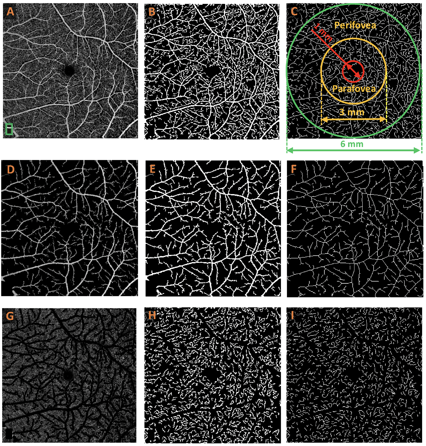 Using a new OCT-A technique to isolate capillaries improved DR classification performance. These images from the study show the process of feature extraction. An OCT-A image of a total vasculature map (A) is captured and then binarized (B) to isolate the vasculature, and then skeletonized (C) to illustrate fovea, parafovea and perifovea areas. Then, a large vessel map (D) is extracted, binarized (E) and skeletonized (F). Next, a capillary map (G) is produced, binarized (H) and finally skeletonized (I).