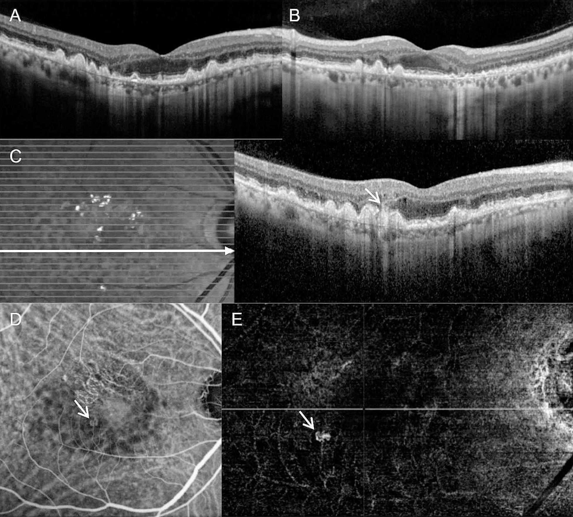 The authors of a new study performed both OCT crosshair and raster scans on the fellow eyes of 75 patients with unilateral nAMD and found that raster scans were more accurate in diagnosing neovascularization in those eyes. A total of 12 cases were missed by OCT crosshair scans alone, according to the study, and detection was more likely to be missed in patients with type 3 MNV. The authors propose OCT raster scans as a routine component of fellow-eye monitoring. These images from the study show a representative case of a patient diagnosed with type 3 MNV in the left eye. Twelve months after the initial diagnosis, there is no sign of fellow-eye neovascularization on horizontal (A) or vertical (B) crosshair OCT images. However, raster scan images show an intraretinal hyperreflective lesion (C, short arrow) accompanied by adjacent retinal edema and disruption of the RPE inferotemporal to the fovea. Type 3 MNV is observed on indocyanine-green angiography (D, arrow) and OCT angiography (E, arrow). The long horizontal arrow on panel C indicates the OCT scanning line.