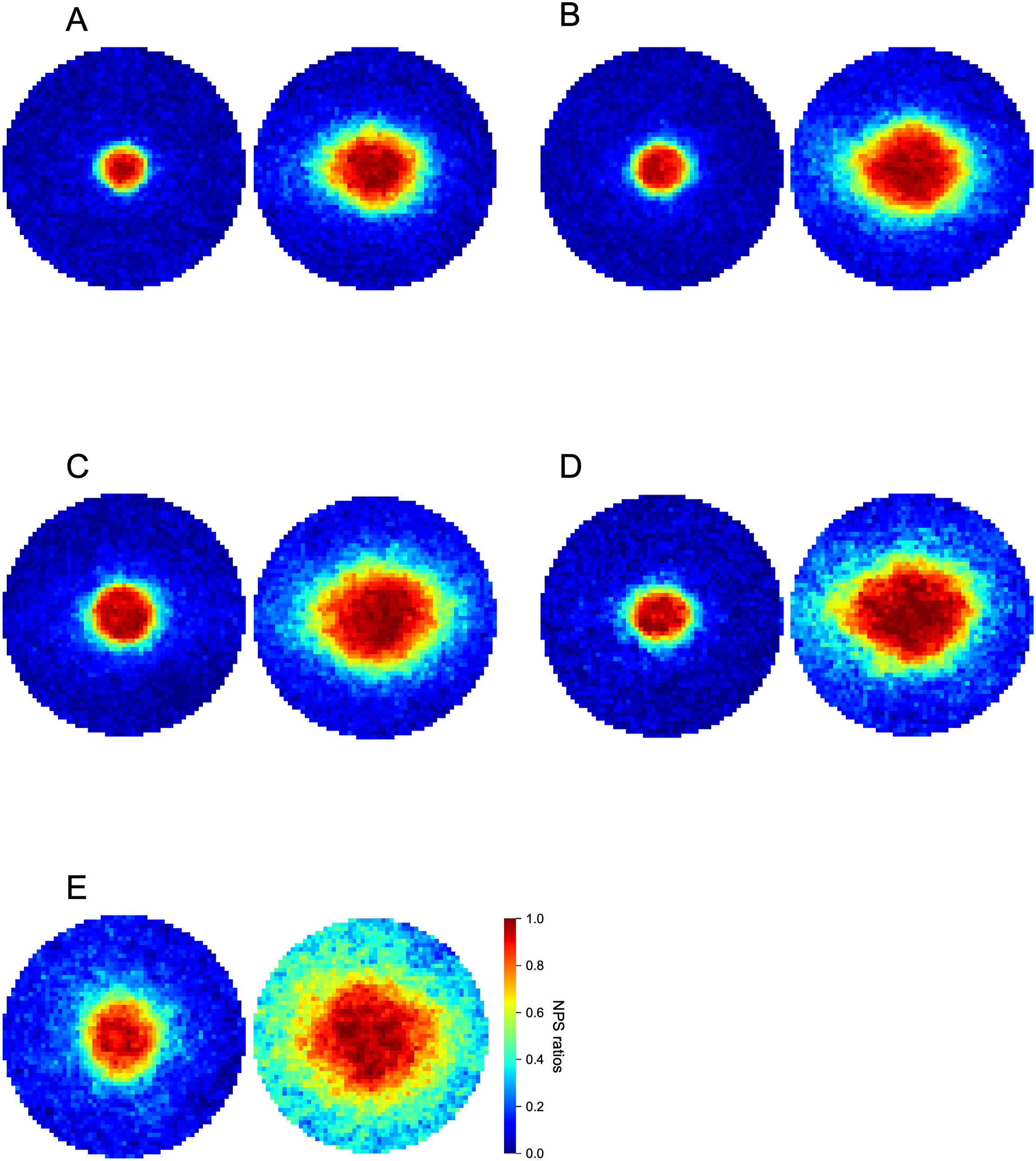 The researchers suggested in their paper that the presence of a superficial and moderate group in the intermediate stage of the disease implies multiple pathways for diabetic macular ischemia progression. This image from the study shows heatmaps of the nonperfusion areas (NPAs) in the superficial (left) and deep (right) layers: (A) The Initial group displays minimal nonperfusion in both. (B) The Mild group shows a mild increase in NPAs in the deep layer. (C) The Superficial group is characterized by larger NPAs in the superficial layer of the central sector. (D) In the Moderate group, the NPAs extended to the temporal subfield in the deep layer. (E) The Severe group is higher in both layers. 