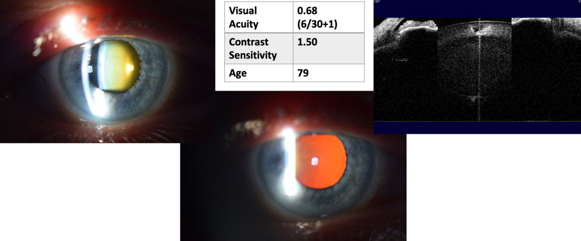 New research supports the notion of considering anterior segment OCT as an adjunct to slit-lamp images to help improve the accuracy of cataract assessment. This image from the study shows slit lamp images, OCT lens section and corresponding visual function measures. 