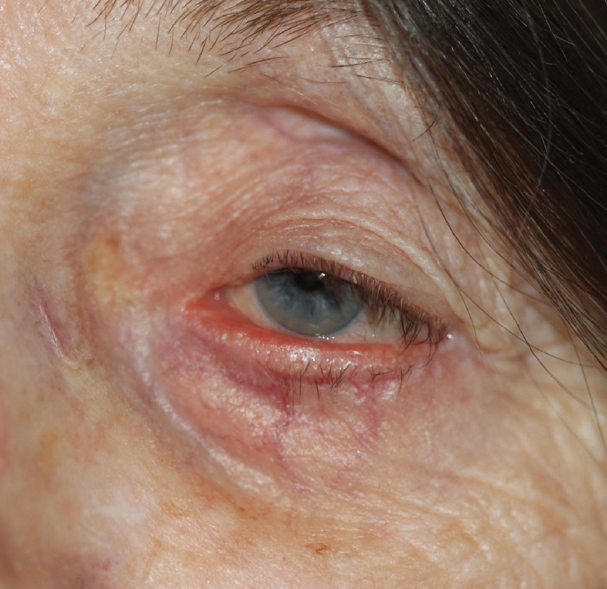 Patients with any of the following inflammatory conditions are at greater risk of developing involutional ectropion, according to a recent study: blepharitis, chalazion, hordeolum, dermatitis of the eyelid, chronic conjunctivitis, pterygium, dyslipidemia or rheumatic disease.