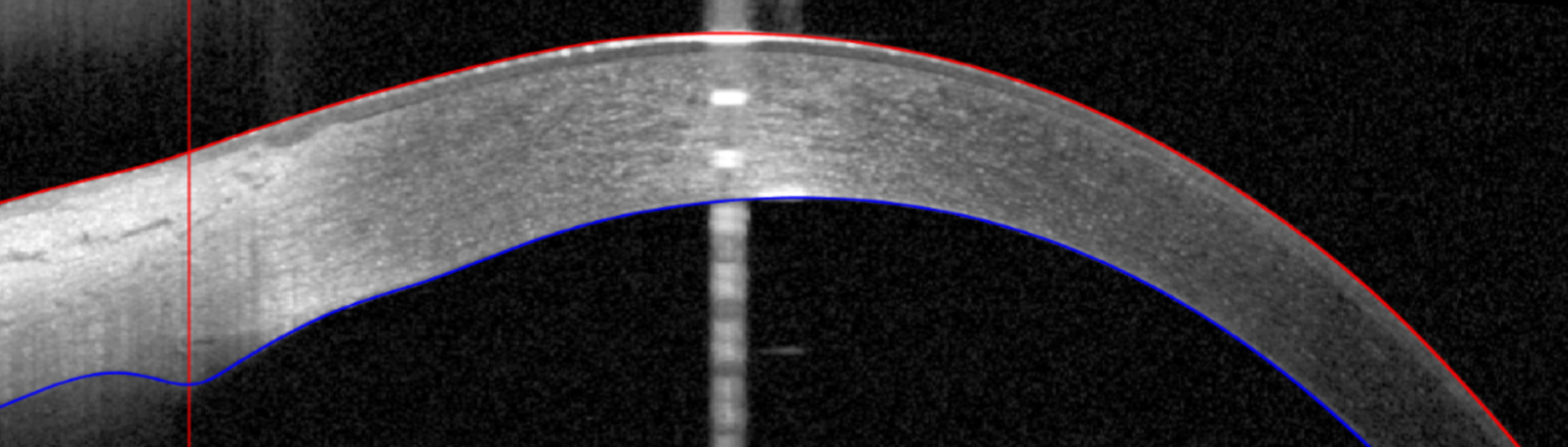 Images were captured more peripherally in the limbal region, and greater peripheral swelling could be related to increased conjunctival/scleral blood flow or thickness, which have been documented following overnight eyelid closure. 