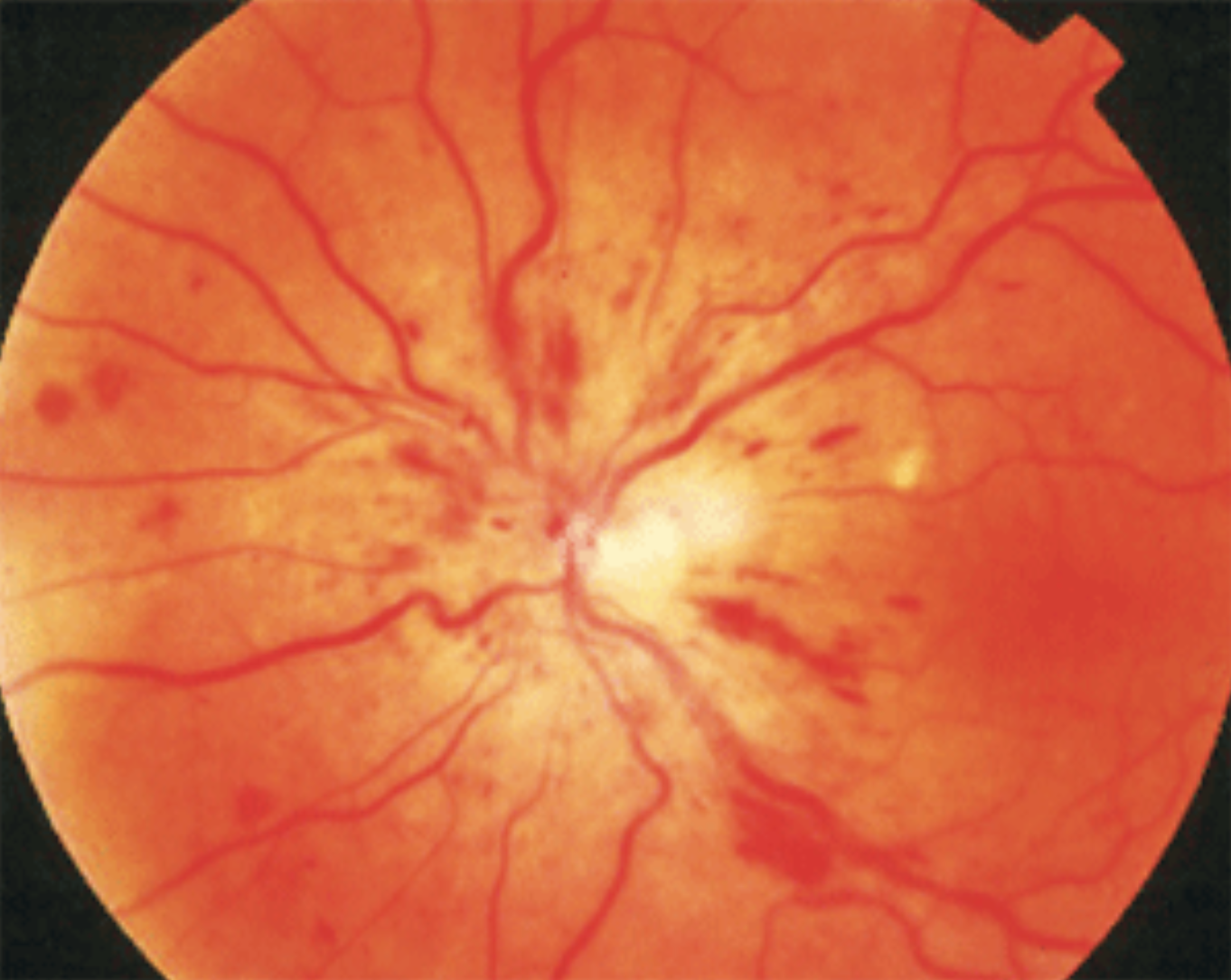 Among 123 patients with CRVO, the cumulative probability of developing NVG was 26.8%, which occurred 507 days after CRVO diagnosis, on average.