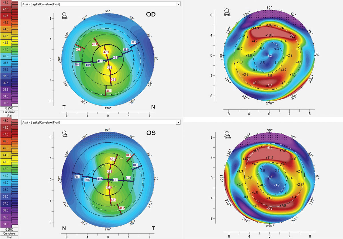 Fig. 1. Corneal topography showing mild apical with-the-rule astigmatism (top and bottom left) and adequate treatment with ortho-K (top and bottom right) both OD (top left and right) and OS (bottom left and right).