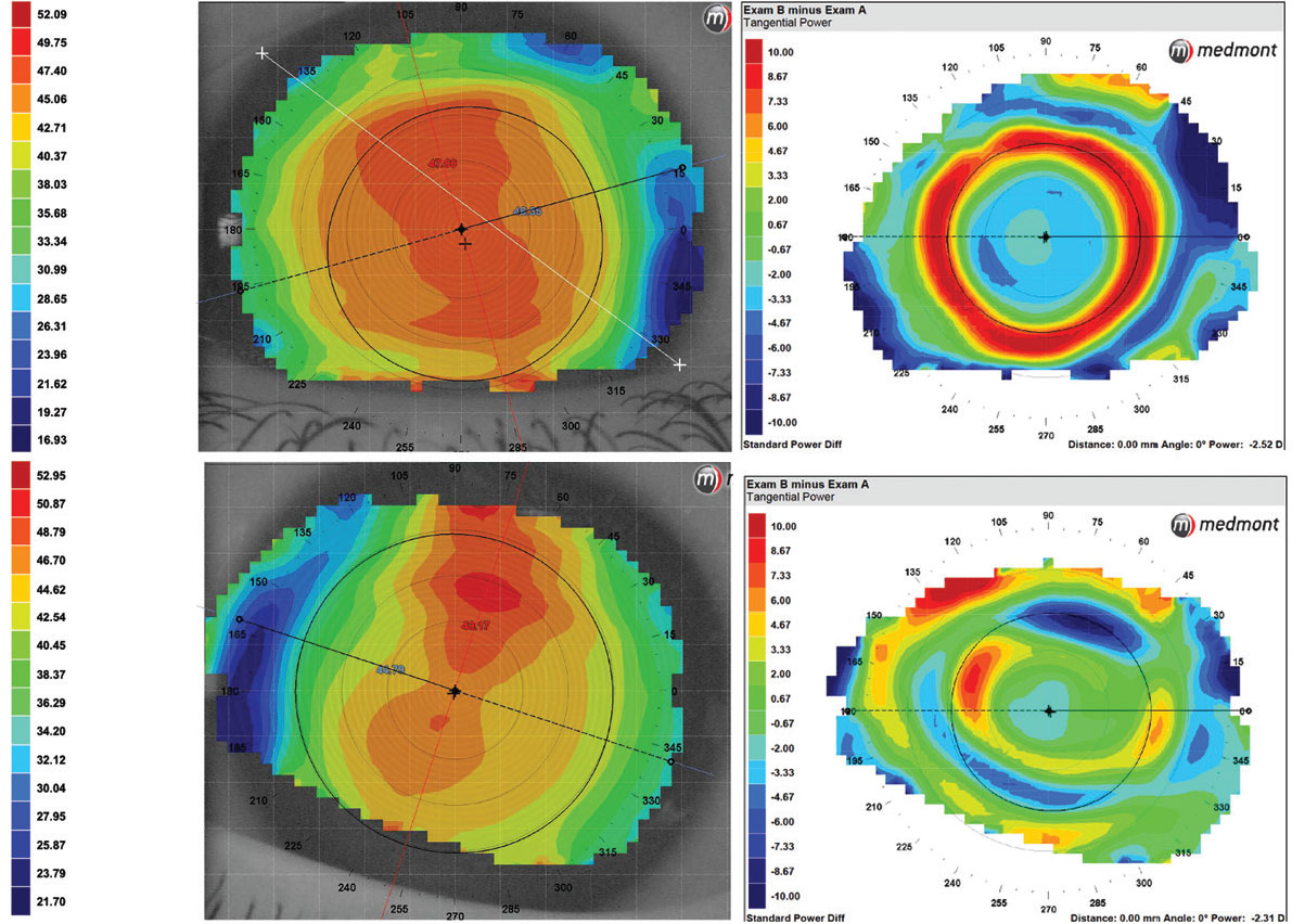 Fig. 2. Corneal topography at baseline visit (top and bottom left) and after ortho-K (top and bottom right) both OD (top left and right) and OS (bottom left and right).