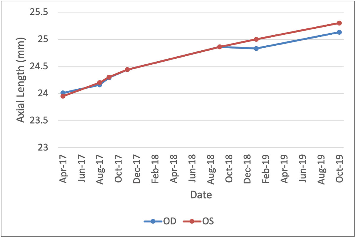 Fig. 4. Axial length progression over time of the right (blue) and left (red) eyes. Soft multifocal lens wear was initiated in August 2017. After poor compliance, the patient was switched to ortho-K in October 2018. Patient reported inconsistent lens wear and low-dose atropine was added in October 2019.