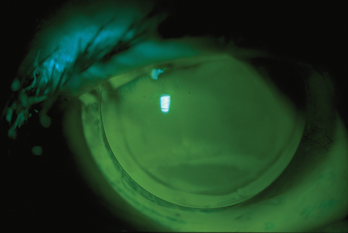 Fig. 2. No specialty CL practice is complete without a concentration in corneal GP contact lenses.