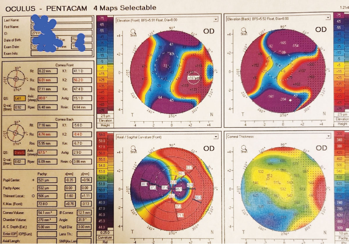 Topography image of a patient with severe irregular astigmatism post-PK.