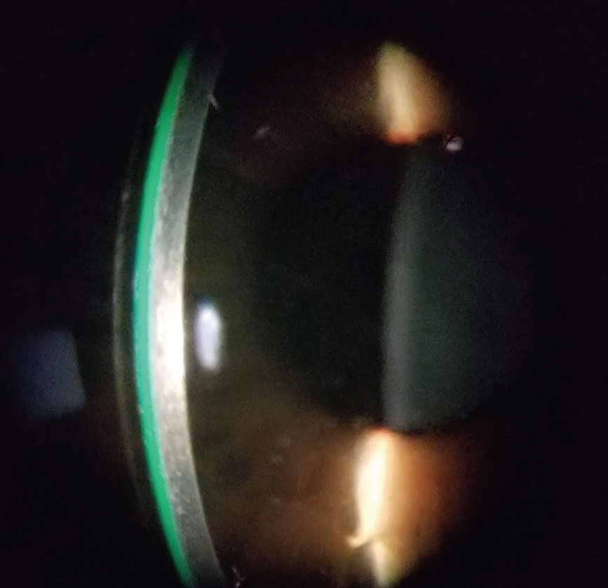 Image of a scleral lens on a post corneal transplant eye.