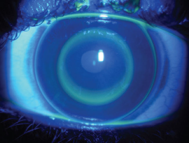 Optimal NaFl distribution for an orthokeratology lens fit in a young adult. Relatively larger back optic zone diameter can be considered to optimize the clarity of distance vision.