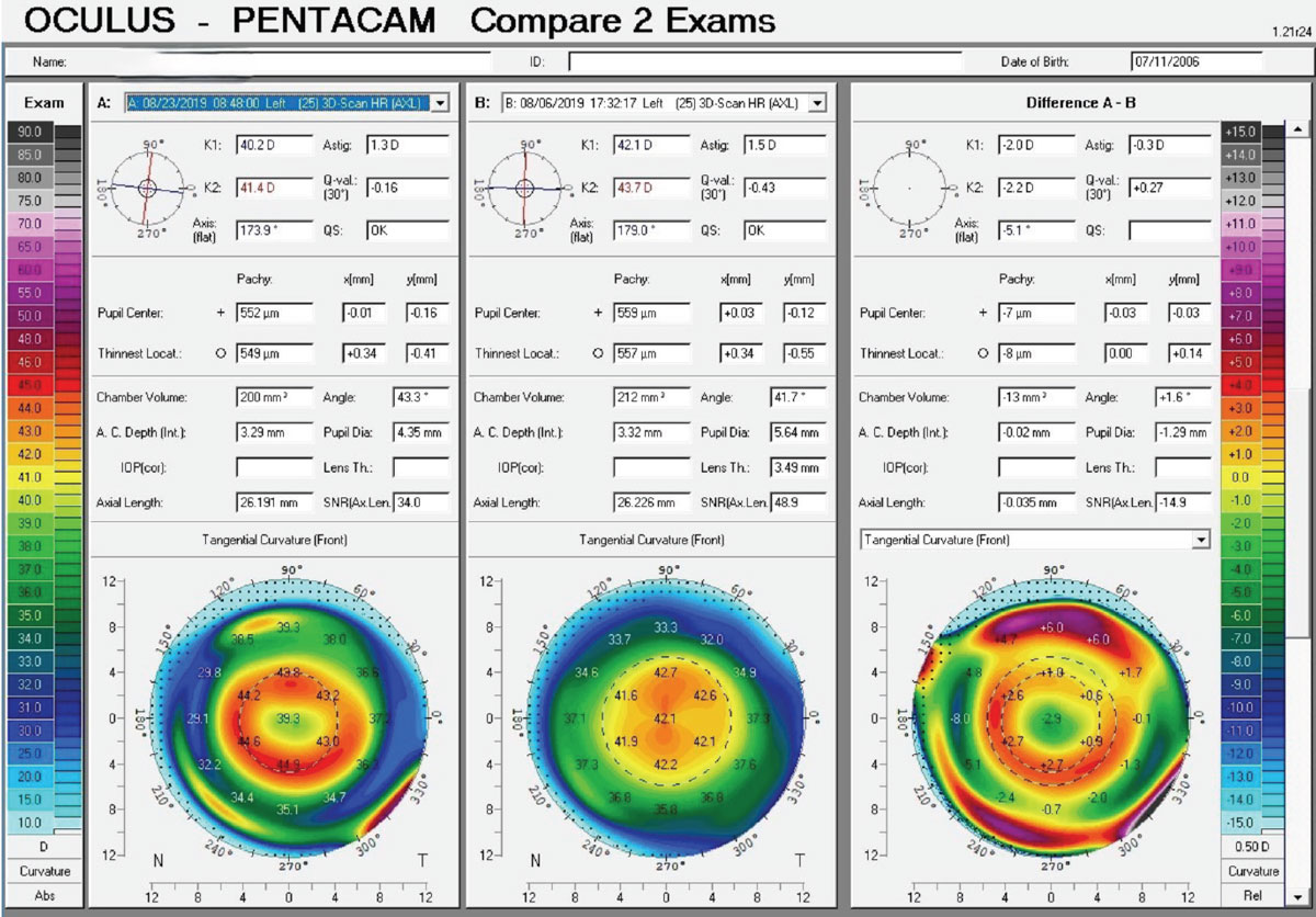 An overview of a two-map tangential comparison between the baseline and the treatment phase, showing the overall centration effect and axial length status.