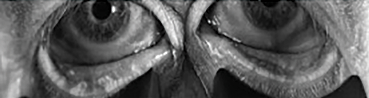 Fig. 2. Bilateral meibography with truncation and presence of tortuosity and segmentation.