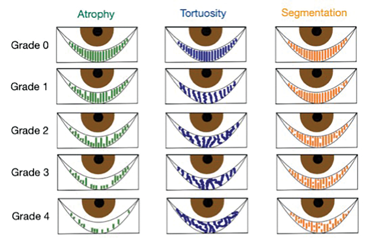 Fig. 3. Puly 5-grade scale for gland atrophy, Halleran grading scale for tortuosity and the segmentation grading scale.