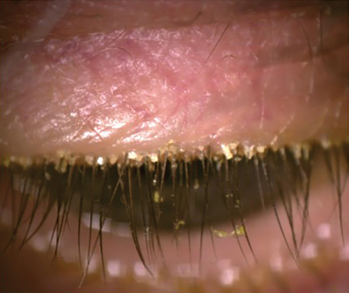 Fig. 4. Presence of Demodex with the patient looking down.