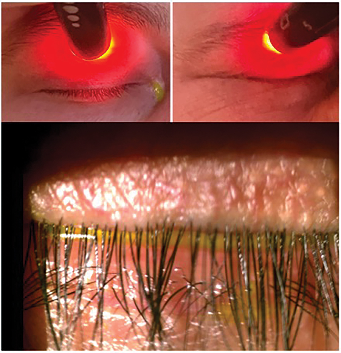 Fig. 5. Korb Blackie test reveals light leakage centrally indicating lagophthalmos (top left). Patient demonstrates no light leakage while squeezing (top right). Slit lamp photo depicting improper lid closure (bottom).