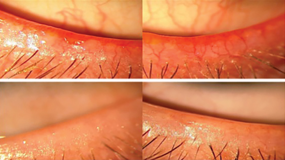 Fig. 6. Lower eyelids with telangiectasia before and after intense pulse light treatment.