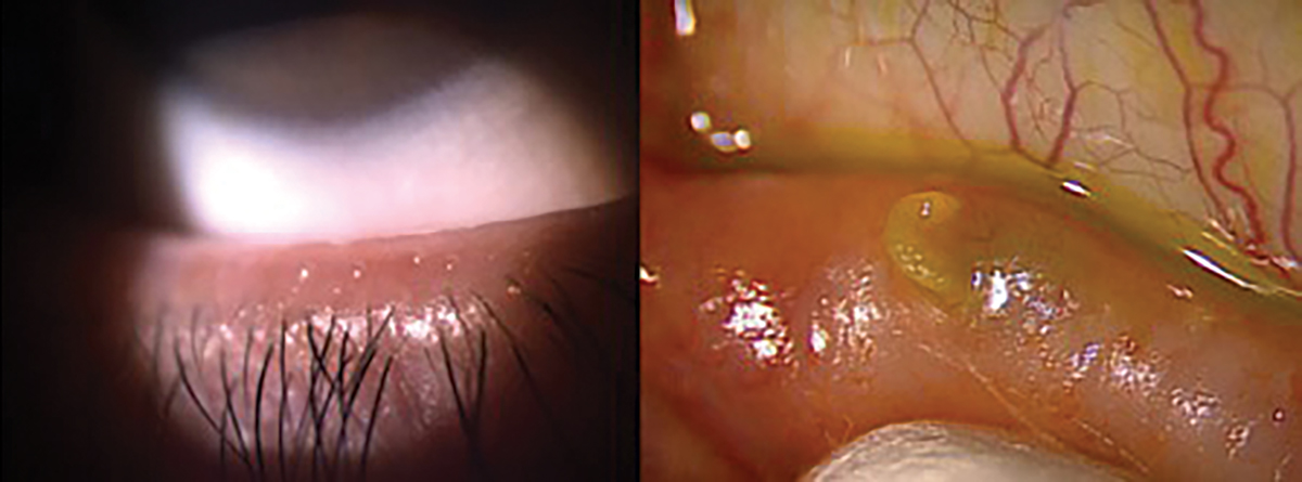 Fig. 7. Proper release of meibum through blinking, grade 0 (left). Expression of hardened meibum, grade 3+ (right).