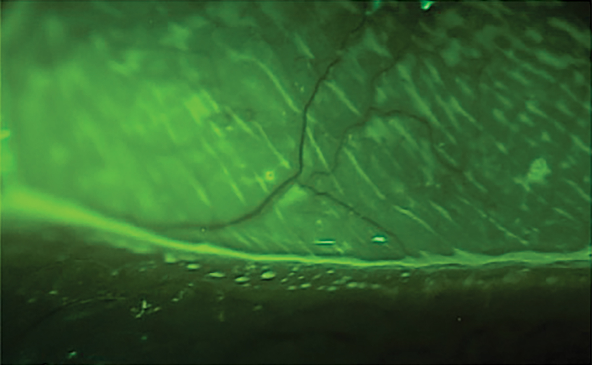 Fig. 8. Low tear meniscus.