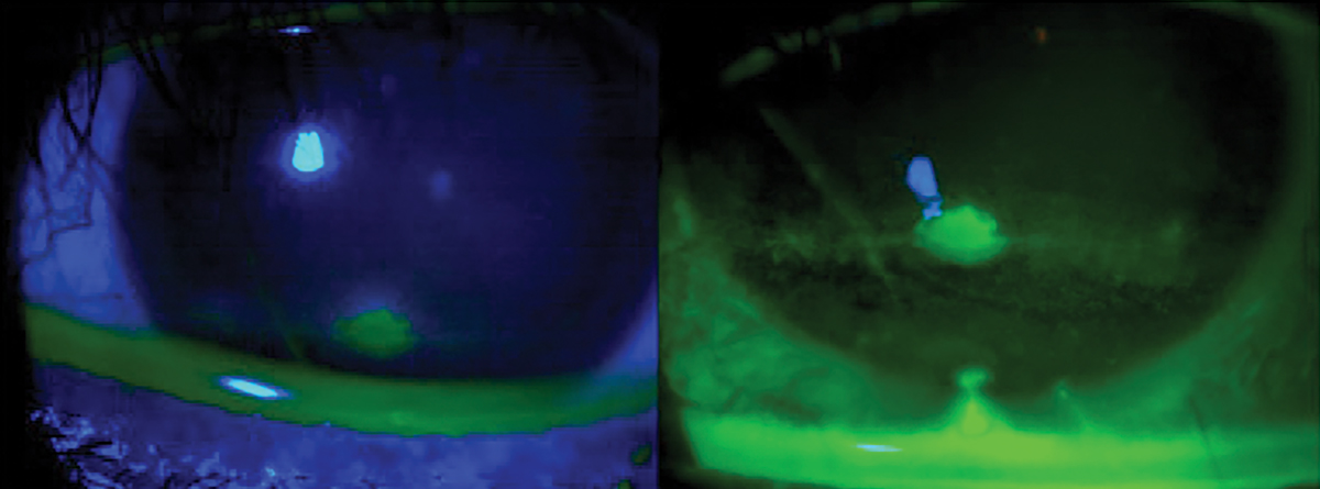 Fig. 9. Ocular surface viewing with just cobalt blue light (left) with a Wratten filter.