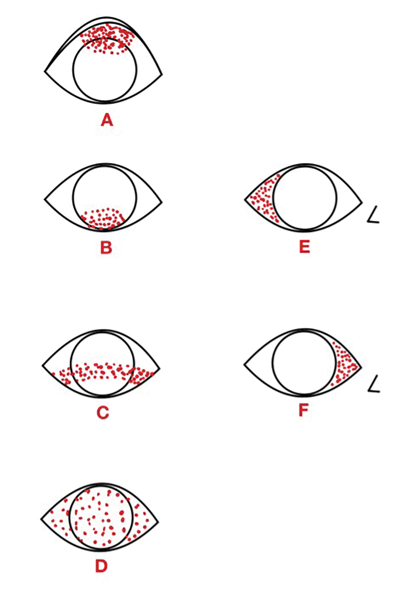 Fig. 10. Common ocular surface staining patterns.