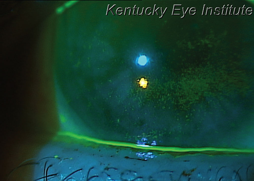 This patient with glaucoma-induced dry eye and a thin tear meniscus could benefit from punctual occlusion.