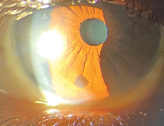 Slit lamp exam of the patient revealed these findings. What might be the prognosis?