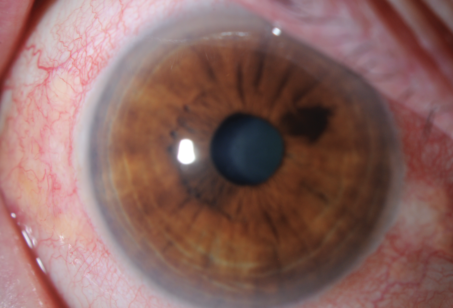 Fig. 1. The affected eye of this patient exhibits characteristic signs of viral conjunctivitis, commonly known as pink eye. The conjunctival blood vessels are visibly dilated, contributing to the overall redness.