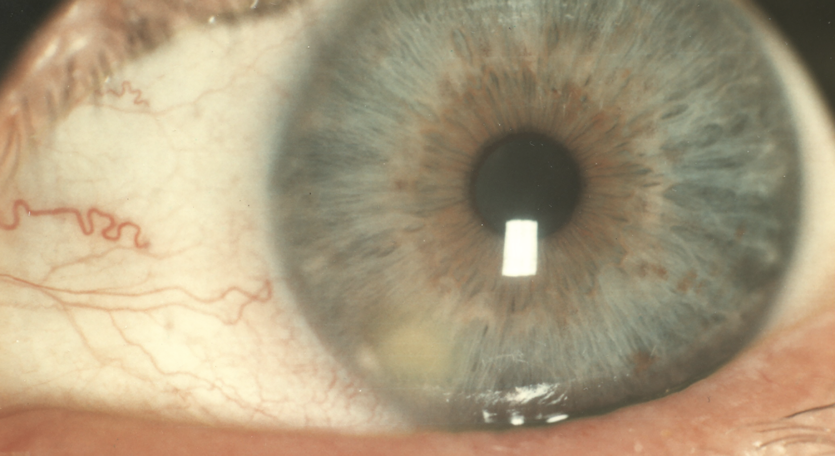 Fig. 2. Note the marginal infiltrate located at the periphery of the cornea, appearing as a small, localized white or grayish opacity, distinctly positioned near the limbus of the eye. Surrounding the infiltrate is a mild conjunctival injection, indicating a localized inflammatory response. This condition is typically associated with inflammatory processes, such as ocular surface disease or contact lens-related complications.