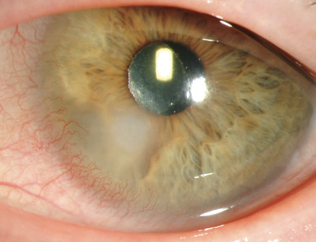 Fig. 4. Extended contact lens wear and poor hygiene practices, such as using tap water to clean lenses, can result in MK, often of a bacterial etiology.