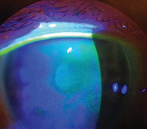 A phase IV postmarket study of three artificial tears found, as one would expect, positive outcomes from the regimen on dry eye patients. Likely more interesting was the influence of differing urban environmental conditions on dry eye signs and symptoms.