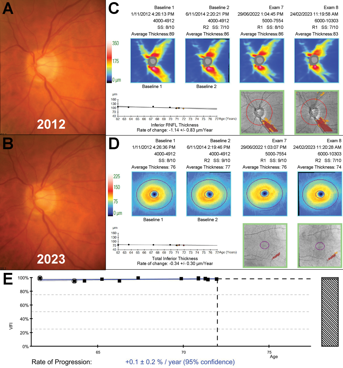 Another impact on the human microbiota comes from the oral cavity, with dysbiosis of the oral microbiome being described to affect the progression of glaucoma. 