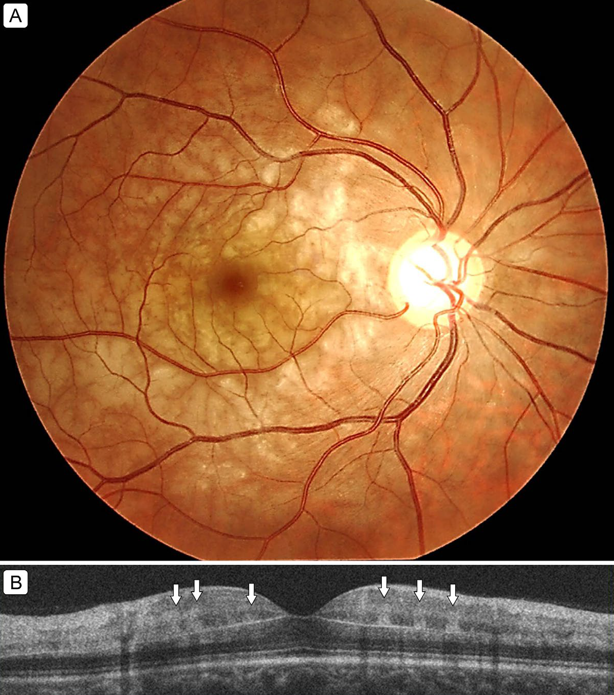 This study found that, compared to patients with PAMM associated with retinal vascular disease, over 90% of those with isolated PAMM had an underlying medical condition, as well as an increased risk of cardiovascular events.