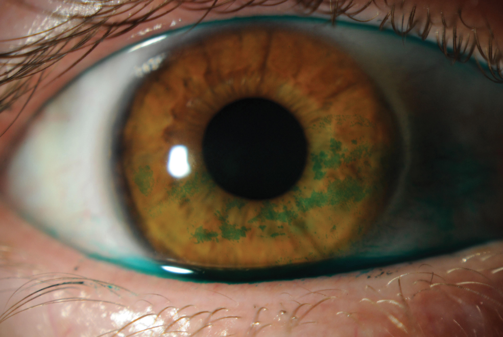 This study explained how applying a lissamine green strip five seconds after wetting it, and then applying the same strip one minute after to the ocular surface was the most optimal way to observe the bulbar conjunctiva, but the amount of dye used for each patient was not measured. 