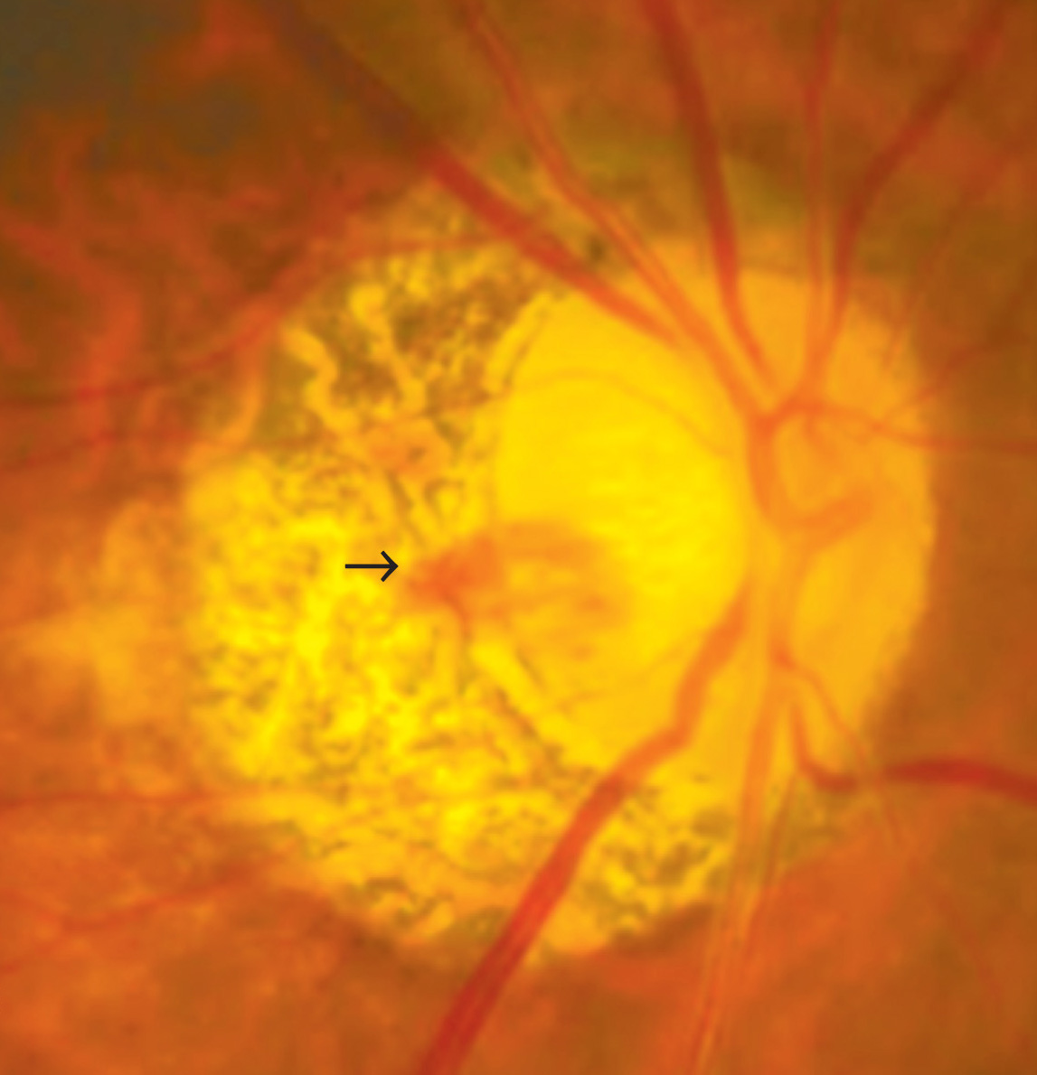 Optic disc hemorrhages are a manifestation of vascular dysregulation in glaucoma caused by shearing of blood vessels in the lamina cribrosa. They have long been associated with disease worsening. This research clarifies the special relevance of the optic cup in their pathogenesis and impact on glaucoma overall.