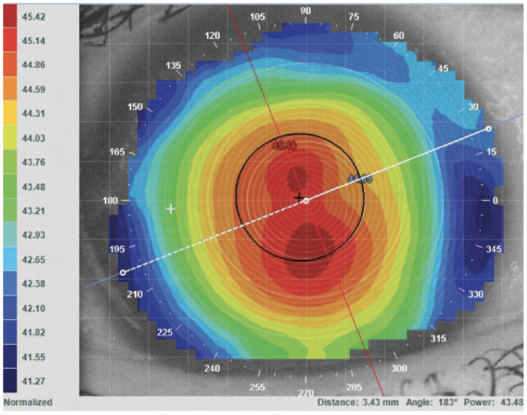 The higher prevalence of astigmatism in Hispanic children indicates a higher risk of meridional amblyopia, while in Black kids the higher prevalence of anisometropia indicates a higher risk of unilateral amblyopia. Additionally, the presence of more outliers with high myopia, high hyperopia and poor vision indicates a higher risk of amblyopia.