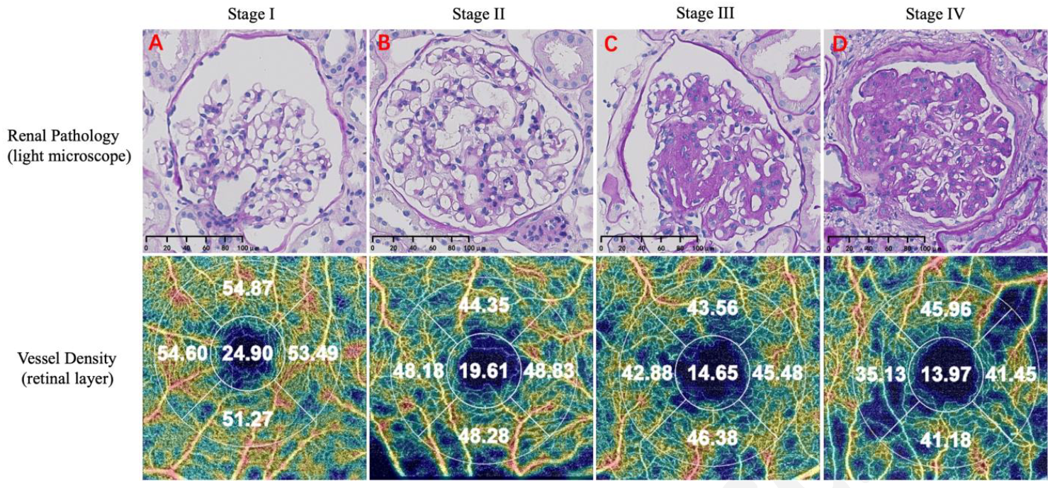 By quantifying the retinal capillary network, OCT-A can detect early microvascular disease and serve as a predictor for kidney function. 