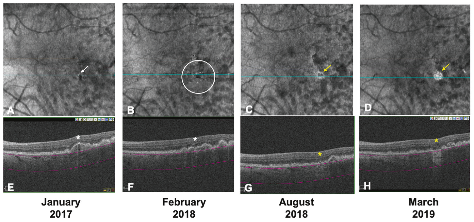 Over two years of follow-up, the majority of eyes with no hypertransmission defects (hyperTDs) at baseline (74.5%) were stable, while eyes with defects (87.5%) were more likely to progress (ORs ranged from 16.1 to 26.4). This image from the study shows an example of an eye with hyperTD with progression: A single small hyperTD (white arrow) is detected on the baseline en face OCT (A). The corresponding horizontal OCT B-scan (E) shows choroidal hypertransmission and a small region of RPE disruption, but no overlying photoreceptor degeneration (white asterisk). The criteria for iRORA are not met at baseline on OCT. Fourteen months from baseline, multiple small hyperTDs (white circle) are evident with a progression to iRORA (B and F). Six months later (20 months from baseline), these small hyperTDs coalesced and developed into large hyperTDs with a hyporeflective core (donut; yellow arrow) on the en face OCT (C) and iRORA (yellow asterisk) on the corresponding B-scan (G). At the final follow-up (26 months from baseline), a large hyperTD without a hyporeflective core (yellow arrow) is evident on the en face OCT (D) with cRORA (yellow asterisk) on the corresponding B-scan (H). This eye is deemed a progression eye.