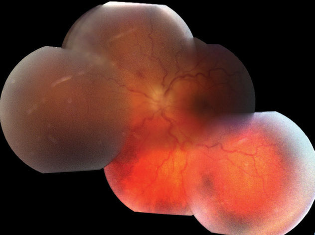 Research shows that timely antiviral therapy is crucial in managing acute retinal necrosis, with early intervention reducing the risk of retinal detachment and vision loss.