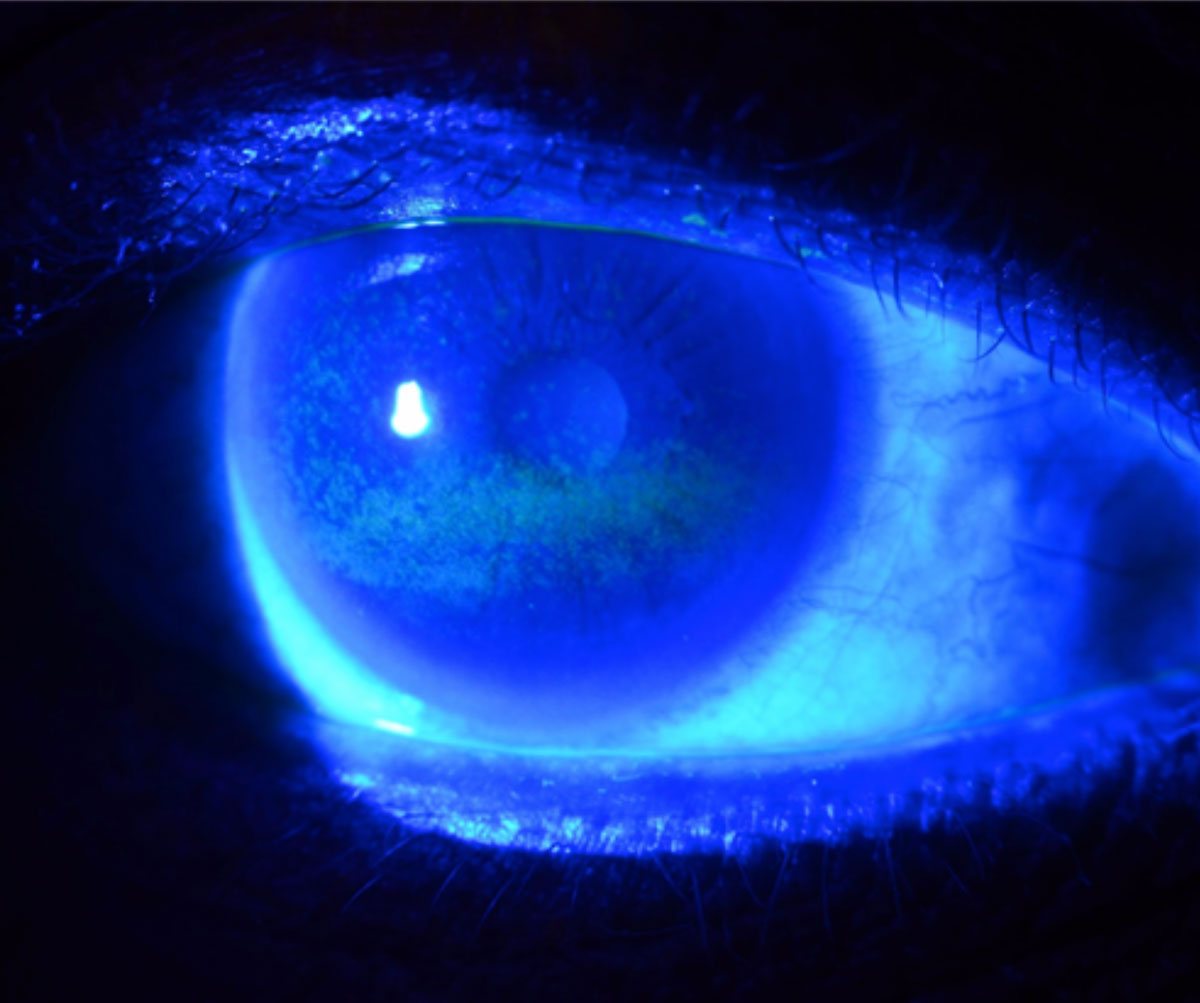 Patients with peripheral neuropathy may be asymptomatic, but they could have underlying signs of dry eye disease. Researchers suggest the DEQ-5 over the OSDI questionnaire as it may be a “more a suitable tool in discriminating symptoms of dry eye disease.”