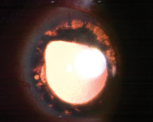 Study reveals high incidence of uveitis in HZO patients, with diagnosis typically occurring in the second week and highlighting the role of early antiviral treatment in reducing vision loss.