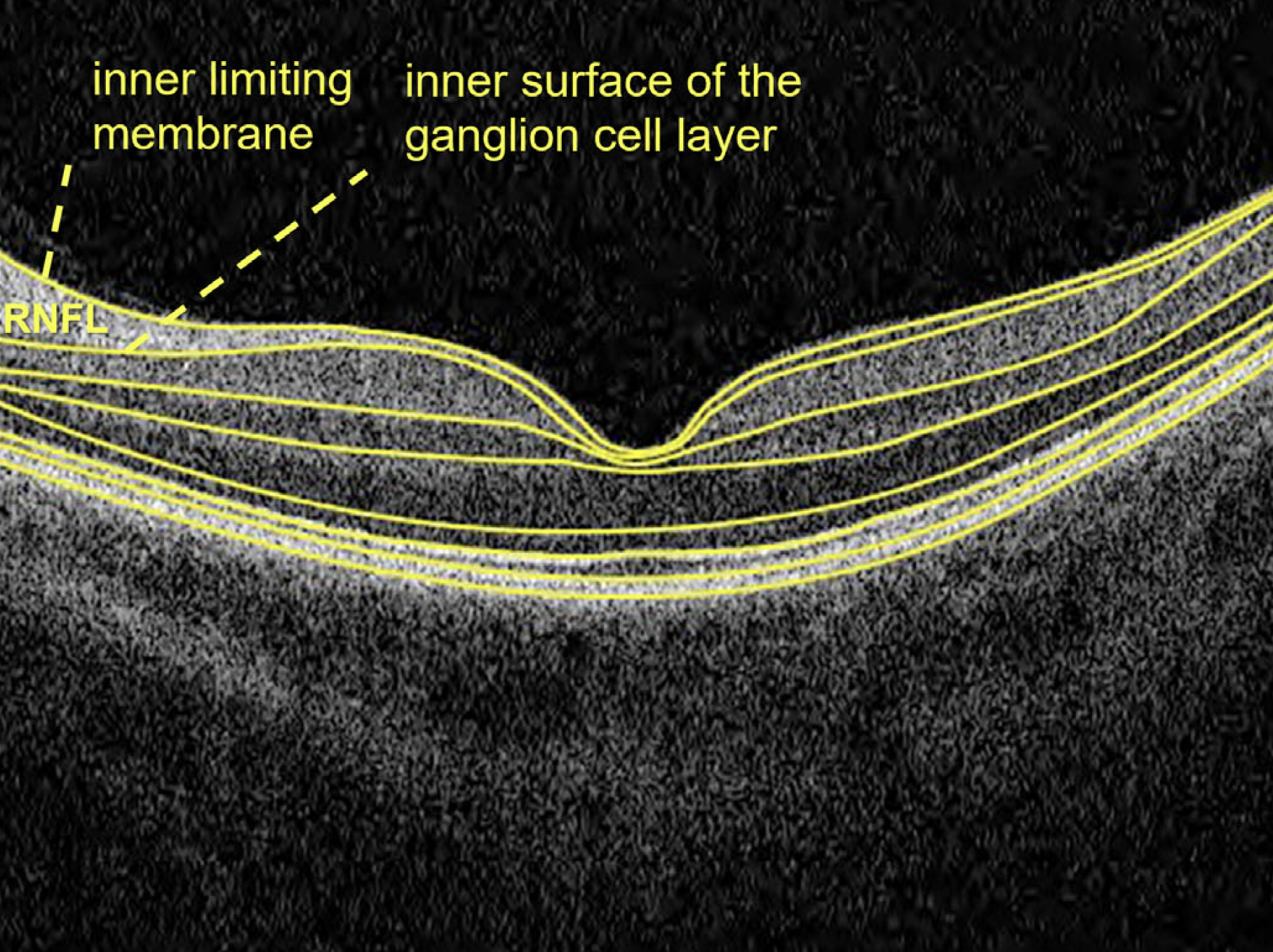 High-density lipoprotein cholesterol has anti-inflammatory properties at certain levels, but it can shift to pro-inflammatory in patients with chronic conditions related to systemic oxidative stress and inflammation. This image from the study shows the segmentation used in their analysis.