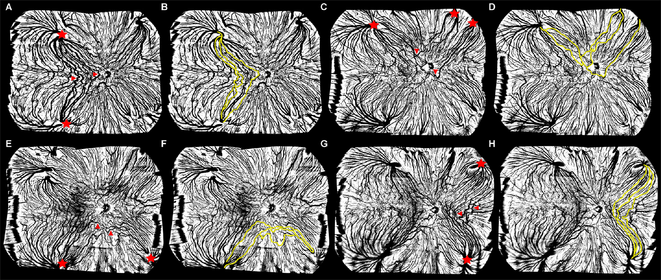 The superotemporal quadrant of the vortex vein drainage system was found to have the thickest choroidal layer and highest choroidal vascularity index. This image from the study shows intervortex venous anastomoses in the temporal (A), superior (C), inferior (E) and nasal (G) quadrants, highlighted in yellow in images B, D, F, and H. Red stars indicate the vortex vein (VV) ampullas in adjacent quadrants, whereas the red arrows refer to the anastomotic vessels connecting the VV ampullas in adjacent quadrants.