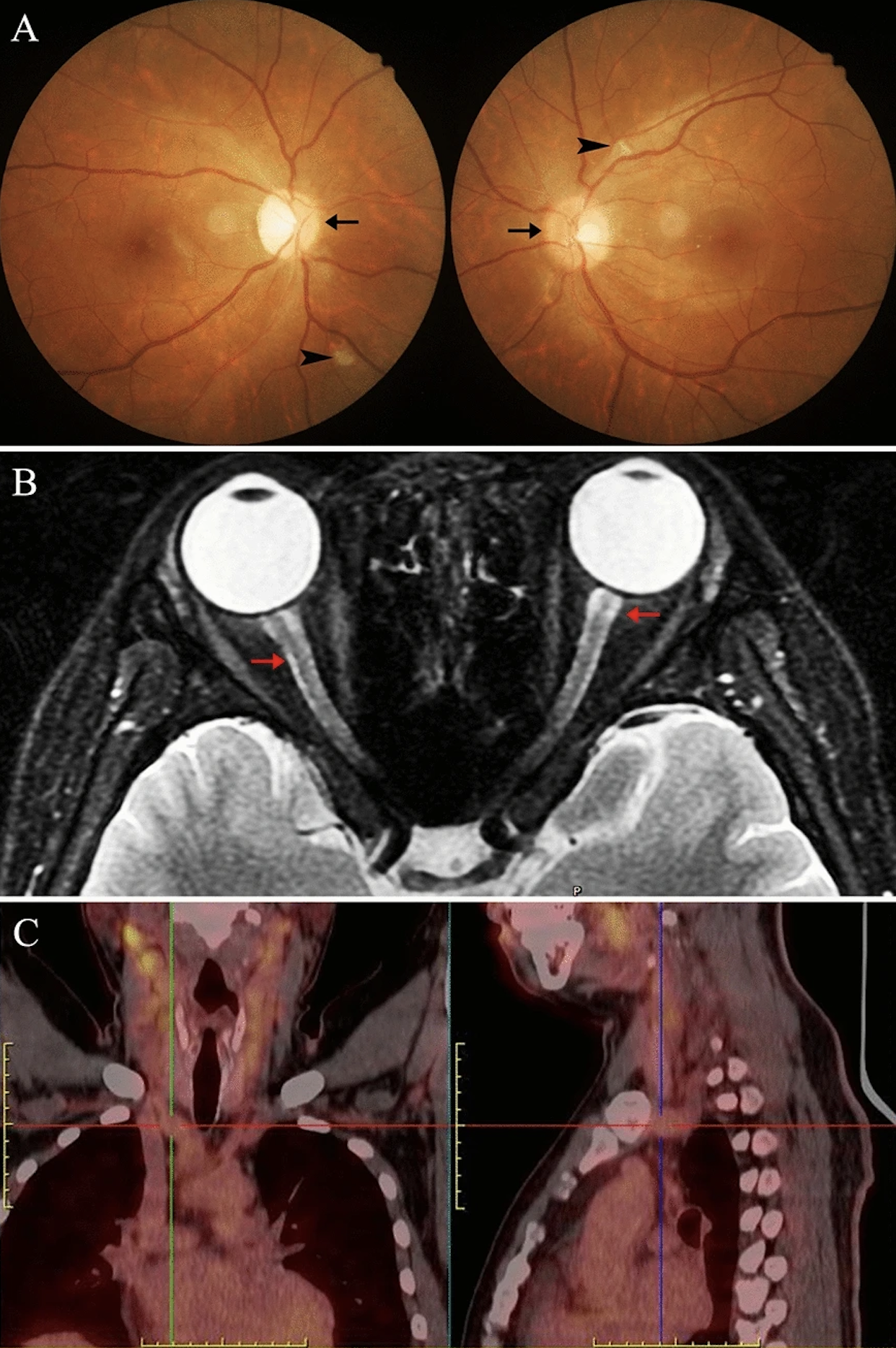 Optic nerve involvement is reportedly 0.8% in granulomatosis with polyangiitis and 8% in microscopic polyangiitis patients. These images from the study show a case of a 32-year-old man with (A) bilateral disc edema and cotton wool spots; (B) discrete T2-weighed hyperintense signal at both the optic nerve and sneath (red arrow); and (C) evidence on PET imaging of multivessel disease through high accumulations of radioisotopes.