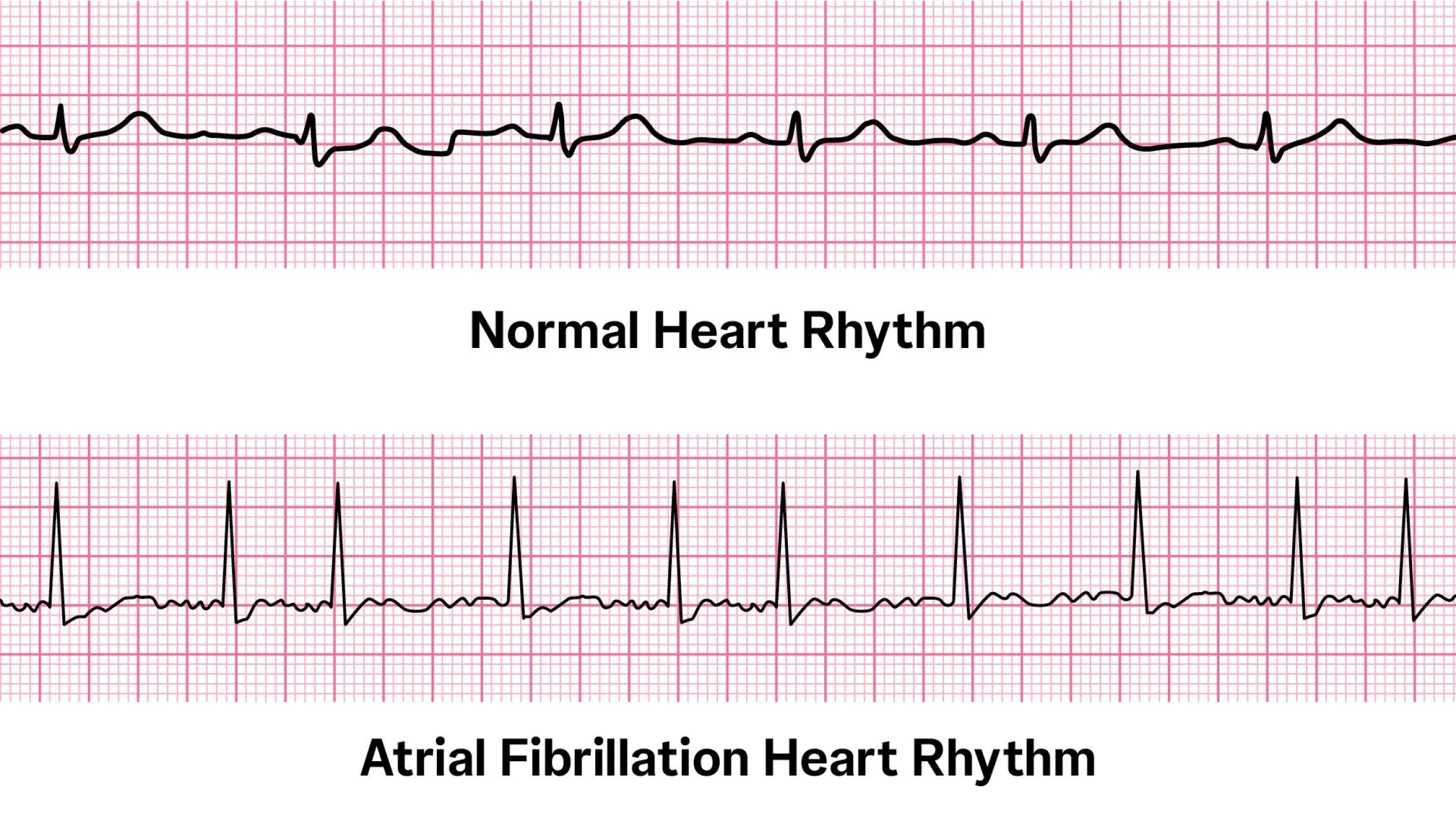 esearchers believe that with the increase in technology for monitoring heart rates (watches and smartphones), better efforts can be made to carefully treat atrial fibrillation and mitigate visual field progression in glaucoma patients.